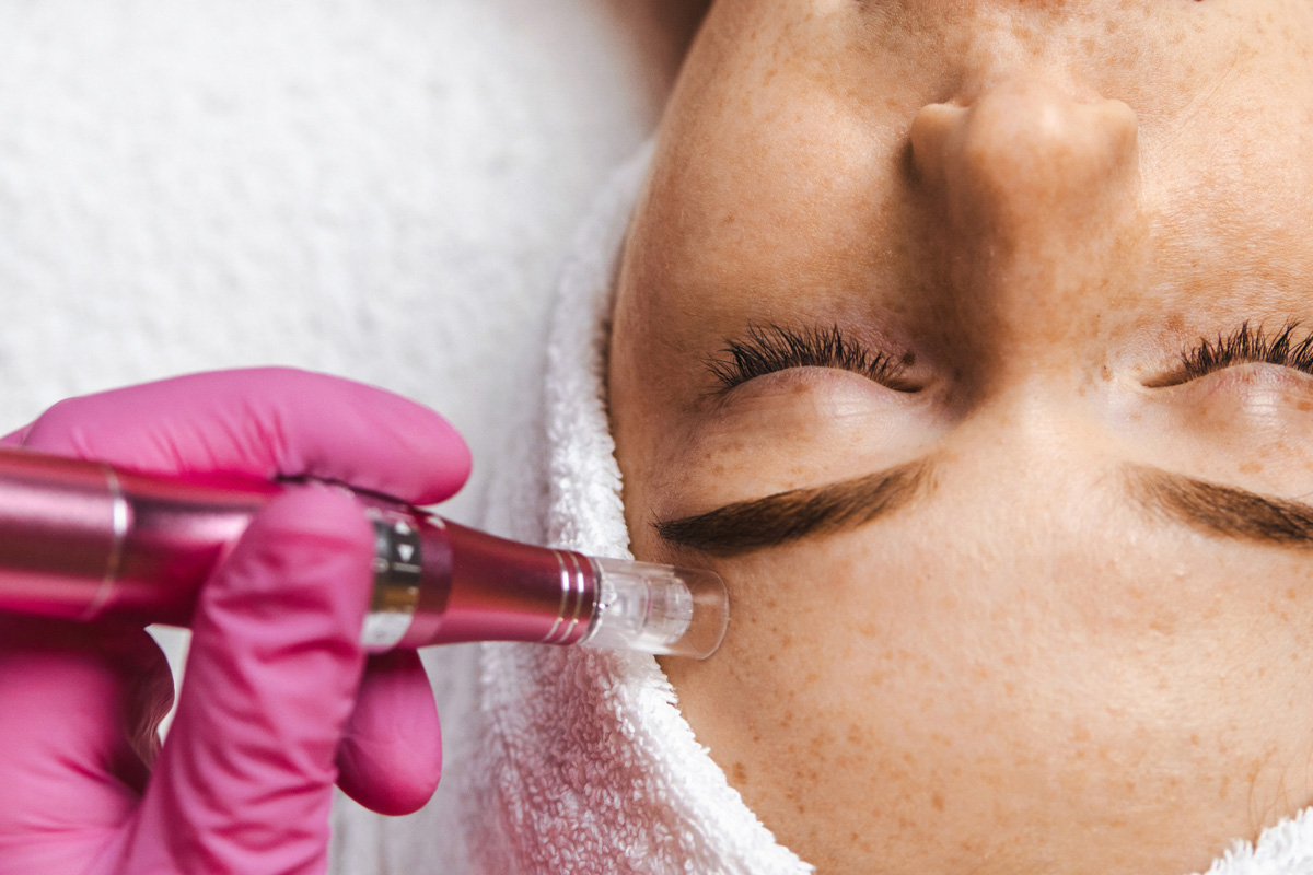 Microneedling colagen