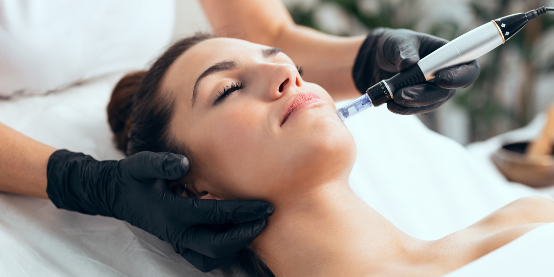 Microneedling rezultat