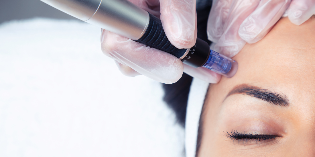 Microneedling tratament